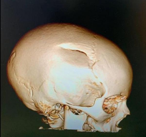 Apresentador Luciano Huck posta foto do crânio do filho e alerta para uso do capacete