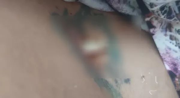 Gaze foi esquecida dentro do corpo de jovem por médicos do HGP e família faz denúncias
