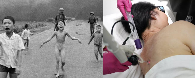 Após 50 anos, garota da foto mundialmente famosa na Guerra do Vietnã passa pelo último tratamento de pele