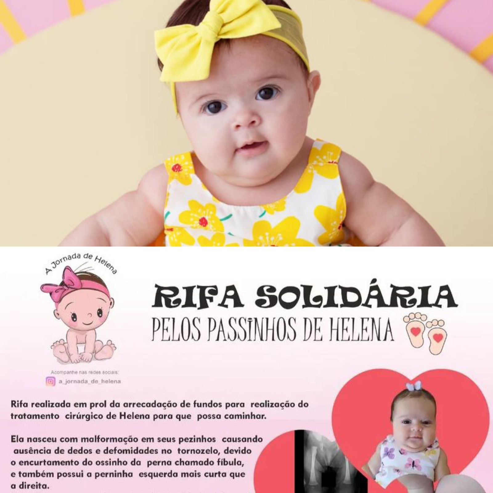 Em Palmas, pais da pequena Helena se mobilizam para custear o tratamento que permitirá que a filha possa andar; veja como contribuir