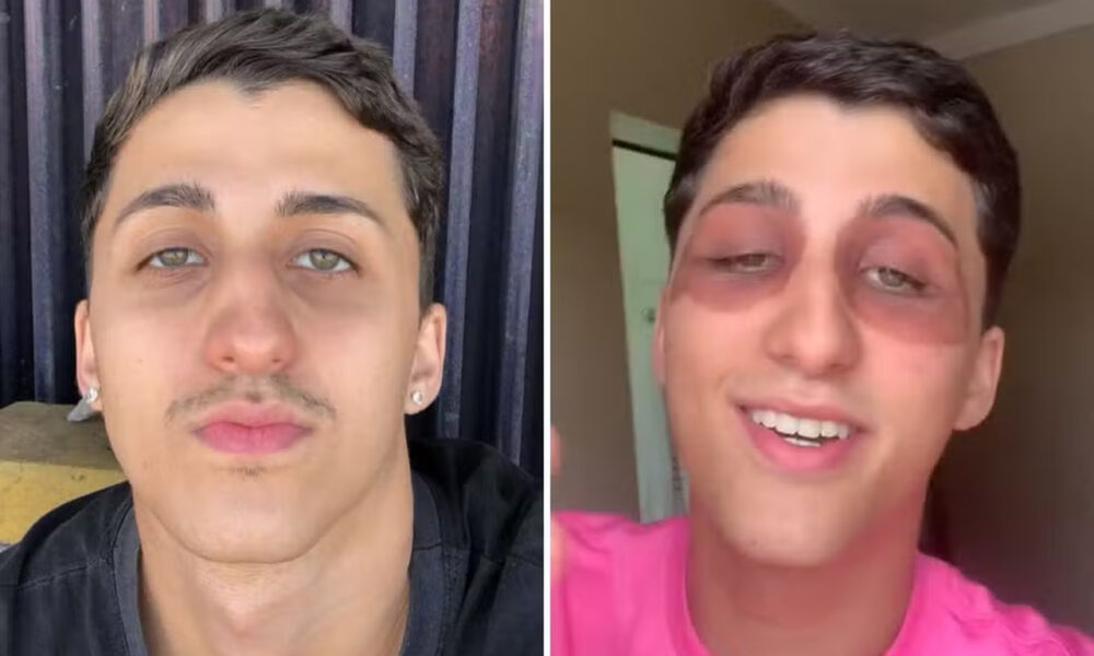 VÍDEO: Jovem de Goiânia intriga web ao mostrar que acordou com hematomas e inchaços nos olhos sem saber o motivo