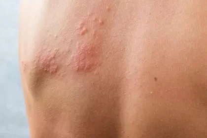 Conheça a Herpes-zóster, doença que atinge quem já teve catapora e pode causar dores fortes