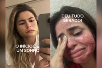 VÍDEO: Médica palmense tem queimaduras graves após peeling; expectativa para pele perfeita resulta em uso de máscara por seis meses