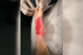 Mulher relata ter sido submetida a curativo sem anestesia no HGP em Palmas; governo do Tocantins promete investigar caso