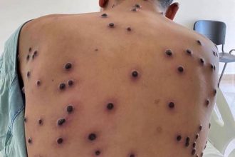 Mpox (varíola dos macacos): conheça os sintomas, formas de transmissão e como se prevenir da doença