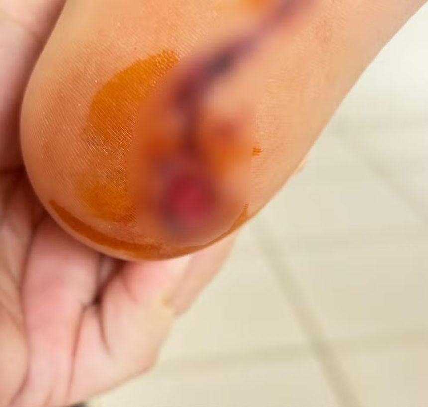 Criança de 8 anos é atacada por piranhas em praia de Palmas; saiba mais