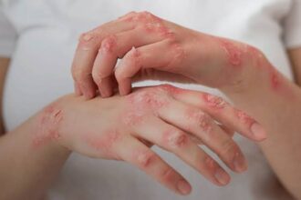 Anvisa autoriza uso ampliado de medicamentos e leva novas opções de tratamento para crianças com lúpus e jovens com esclerose múltipla